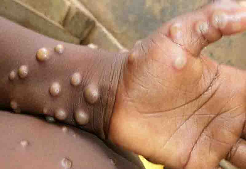 You are currently viewing Monkey Pox Outbreak: Ghana records four deaths, 116 cases