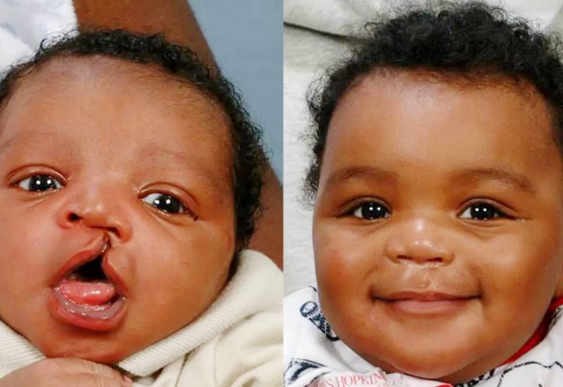 Read more about the article Superstition and Stigma: How mother of seven nearly scarificed cleft child
