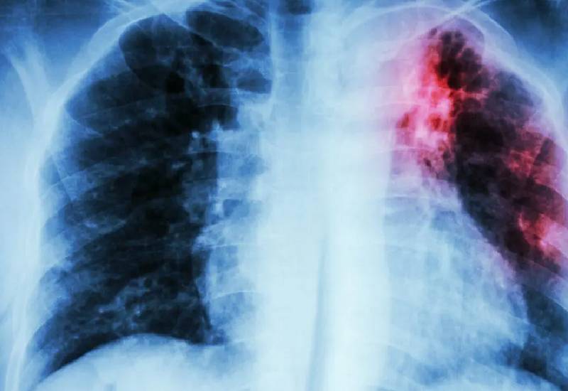 You are currently viewing TB Patients to take less medicines for treatment come October 2023